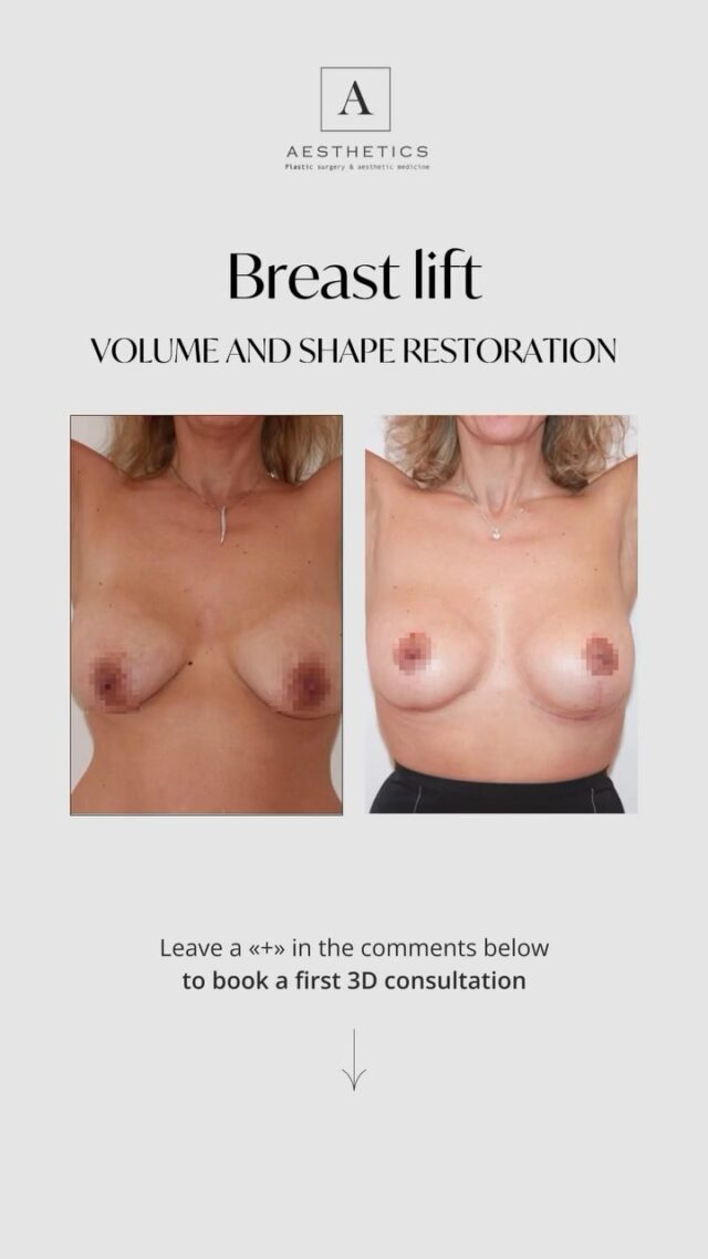 Over time — whether due to pregnancy, breastfeeding, or significant weight loss — the breasts may lose their firmness and shape. This is completely natural, and thankfully, it’s also something that can be addressed.

🔹 What is a Breast Lift?
A breast lift (mastopexy) is a surgical procedure designed to lift and reshape the breasts without increasing their size. If needed, it can be combined with implants or a breast reduction.

🔹 What does a mastopexy do?
— Lifts the breasts to a higher position
— Restores symmetry
— Corrects the shape and position of the areolas
— Helps you feel confident and comfortable in your body

💬 Many women say: «I don’t want bigger breasts — I just want them back.» That’s exactly what a breast lift is for.

If you’ve been thinking about taking this step, we invite you to a free consultation with our expert team.

📞 Booking contacts:
Geneva: Call +41 22 732 22 23 or WhatsApp at +41 79 931 20 66
Montreux: Call +41 79 908 98 98
Gstaad: Call +41 79 196 98 69

#BreastAugmentationGENEVA#AugmentationMammaireGenève#MinimallyInvasiveBreastAugmentationGENEVA#BreastLiftGENEVA #BreastImplantsGENEVA#NaturalBreastAugmentation#BreastEnhancementGENEVA #MastopexyGENEVA#ImplantsMammairesGenève #AugmentationSeinsGenève#LiftingMammaireGenève #AugmentationMammaireMinimaleGenève#LipofillingSeinsGenève#drTenorio#aestheticsclinic