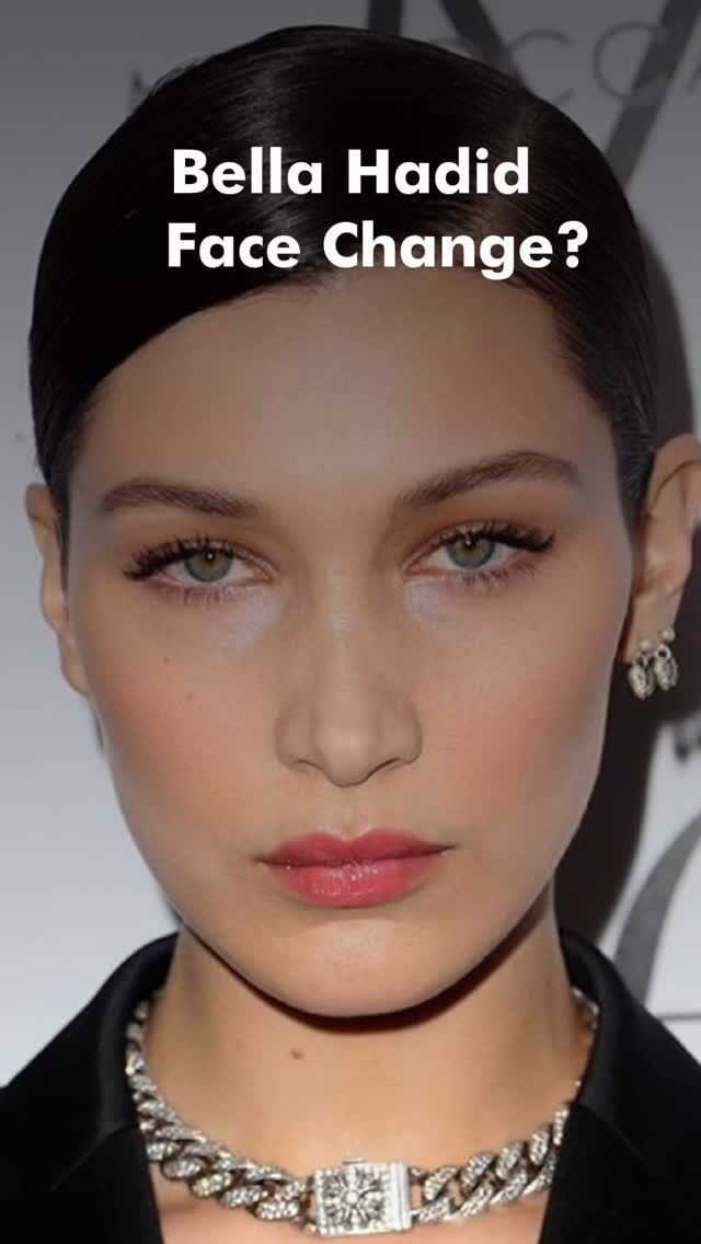 ✨ How Did Bella Hadid Transform? Subtle enhancements that inspire.

Bella Hadid is one of the most striking examples of how modern aesthetic techniques can subtly enhance natural beauty and bring refined elegance to facial features.

What changed?
💉 Elegant nose refinement (possibly non-surgical rhinoplasty)
💉 Cheek and chin contouring — for harmony and definition
💉 Lip fillers — delicate volume without heaviness
💉 Fox eyes — achieved through thread lifting or botulinum therapy

These changes didn’t make her someone else. They simply revealed what was already beautiful — enhancing her features, boosting her confidence, and creating that iconic look.

Because ideal proportions aren’t about a template — they’re about balance, light, and thoughtful accents.

💎 Special offer: -30%  on HA injections — only until the end of June!

❕Check our highlights to claim your voucher — it’s the perfect moment to enhance your natural beauty, at a lovely price.