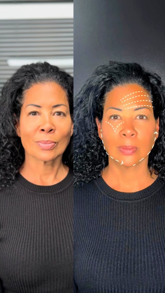 ✨ Witness the Incredible Results of the Soft Lift Procedure! ✨
We’re thrilled to share the amazing transformation of our beautiful patient, Tonya, who recently underwent a delicate first session of her SOFT LIFT  treatment to enhance her natural beauty and define the perfection of her face .

💉Baby BTX : We relaxed her forehead activity to lift her eyebrows. 

🌟 Cheek Contour: We accentuated her cheekbones, creating youthful contours that add a vibrant lift to her face.
👀 Under-Eye Improvement: Take a closer look at the under-eye area—thanks to our targeted approach, we’ve effectively eliminated the hollows, resulting in a refreshed and bright appearance.
💫 Chin Definition: The improvements in her upper face have positively influenced her chin line, showcasing how this treatment works harmoniously across the features.
This initial session has already made a noticeable difference, and we’re excited to see the results after her next appointment!
✨ Ready to experience your own transformation? Click links in bio or call our clinic to book your appointment today! 

What aspect of these results do you find most impressive? Share your thoughts in the comments below! We love hearing from you! 💬✨