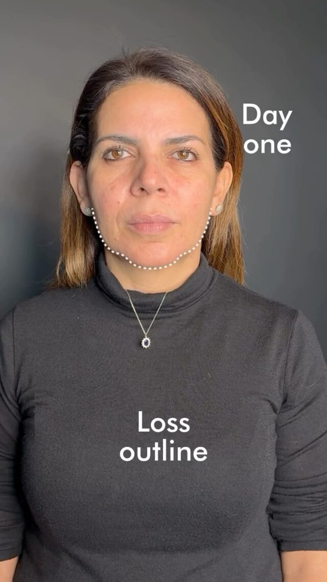 ✨ 2 weeks after the procedure.
In the video — the result of our patient Irene, after precise work on the anatomical angles of the face: the chin and jawline.

👤 Before the procedure:
With age, facial bone structures lose volume, the contour fades and becomes less defined — a typical loss of outline. The bones themselves begin to retract inward, reducing support and leading to changes in overall facial expression: signs of tiredness, lack of definition, and imbalance.

💉 What we did:
— restored the chin angle
— defined the mandibular angle
— brought back structural support and facial clarity

◾️ We don’t transform faces — we restore the natural architecture time has taken away.
◾️ Volume. Support. Balance.
◾️ All with deep respect for your individuality and natural beauty.

Book a free consultation — we’ll create a personalized treatment plan tailored to your facial anatomy.