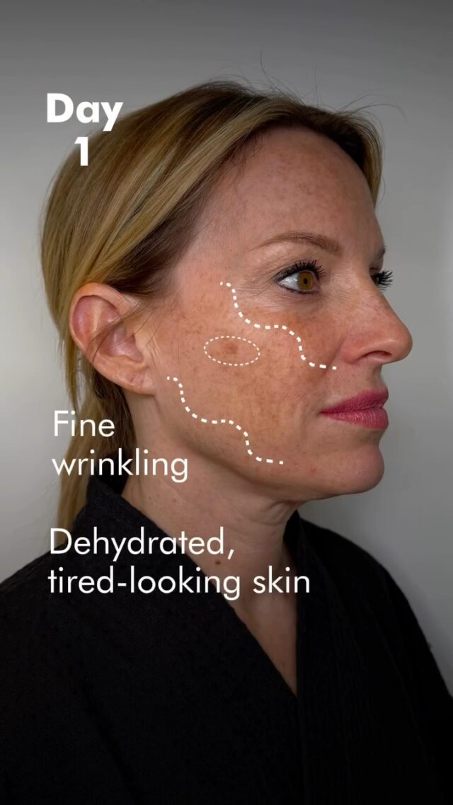 ✨ Red Carpet Skin — No Filters Needed
Remember our lovely patient Maëlle? She came to us with two main concerns:

1️⃣ Dryness, dullness, and fine lines, caused by hormone therapy for cancer prevention (artificially induced menopause through estrogen blockers).
2️⃣ Skin laxity in the neck and chin area.

To restore glow, hydration, and firmness, we recommended:

💧 The Monaco Cocktail — the go-to skin booster celebrities choose before stepping onto the red carpet.

What’s inside:
• A skin booster for deep hydration and improved density
• Vitamins B & C — for skin radiance and elasticity
• And a “secret ingredient” 😉 that relaxes surface muscles, smooths fine lines, and tightens pores (since enlarged pores often result from skin tension)

✨ What changed:
— Fine lines visibly reduced
— Skin appears firmer and fresher
— Radiance and smooth texture restored

📌 In Maëlle’s case, we also used Volite by Juvéderm, one of the densest fillers, to create a supportive framework for the neck and jawline.

Due to prominent Venus rings, the filler was placed directly into the neck lines — this helped support the tissues and provided a subtle lifting effect.

⚠️ Important: this is not a lifting procedure, but a treatment focused on skin quality, hydration, and tissue reinforcement.

🎥 One more visible effect: a noticeable reduction in pigmentation.

Maëlle’s skin now looks firm, glowing, and ready for the spotlight.

📩 Wondering if this treatment is right for you?
Book your free consultation today — link in bio or DM us.

#SkinBooster #MonacoCocktail #JuvedermVolite #VenusRings #GlowUp #SkinQuality #RedCarpetSkin #BeforeAfter #AestheticClinic