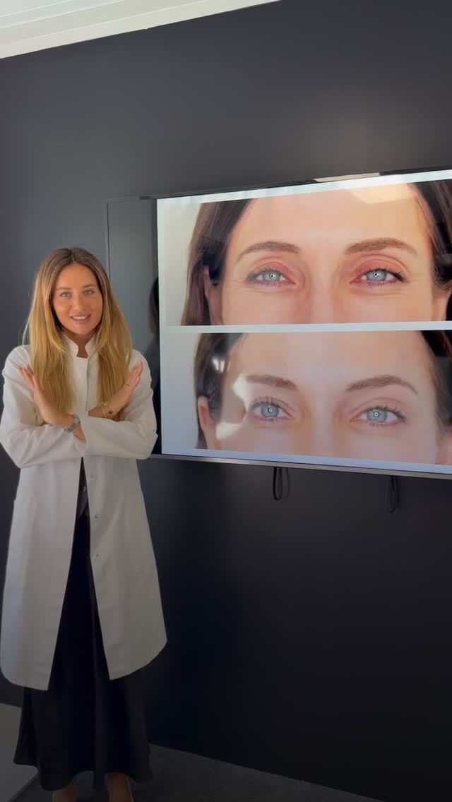 💉 Botulinum toxin Aftercare – What Not to Do (Backed by Science)

To ensure your treatment is safe and effective, here’s what you should avoid after Botulinum toxin — based on peer-reviewed medical research:

🔥 1. No heat exposure for 24–48 hours
Avoid saunas, hot showers, steam rooms, tanning beds.
Why: Heat causes vasodilation (widening of blood vessels) which may increase diffusion of botulinum toxin beyond the target area.
Source:
Goldberg DJ. Botulinum Toxin in Aesthetic Dermatology. Clin Plast Surg. 2011.
https://pubmed.ncbi.nlm.nih.gov/21527394/

🏃 2. Avoid strenuous physical activity for 24 hours
No intense workouts, yoga, running, etc.
Why: Exercise increases circulation and internal temperature, possibly accelerating toxin migration.
Source:
de Morhy Borges et al. High Levels of Physical Activity Reduce the Esthetic Durability of Botulinum Toxin Type A. 2023.
https://www.ncbi.nlm.nih.gov/pmc/articles/PMC10357882/

✋ 3. Do not massage or touch the treated area for 24–48 hours
No rubbing, facial rollers, or applying pressure.
Why: Manual pressure may move the toxin to unintended muscles, reducing treatment precision.
Source:
Ramirez-Castañeda et al. Post-treatment advice following botulinum toxin injections: A review.
https://www.researchgate.net/publication/325561272

🛌 4. Do not lie down for at least 4–6 hours after treatment
Remain upright to allow the toxin to stabilize in place.
Why: Gravity may affect diffusion if lying down too soon.
Source:
Lockhart Matter Dermatology.
https://www.lockhartmatterdermatology.com/lying-down-after-botox/

🍷 5. Avoid alcohol for 24 hours
Why: Alcohol increases blood flow and may enhance bruising and diffusion.
Source:
Sattler G. Botulinum Toxin in Aesthetic Medicine. 2020.
https://www.ncbi.nlm.nih.gov/books/NBK554400/