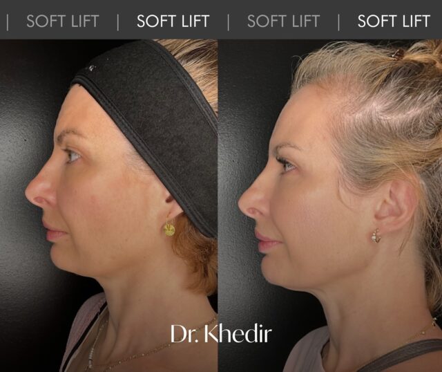 Vous aimez le résultat ?
Si vous souhaitez savoir comment la Dr. Monia Khedir a obtenu un tel résultat de rajeunissement naturel chez notre jolie patiente, tapez « + » en commentaire et nous poursuivrons la série de publications.