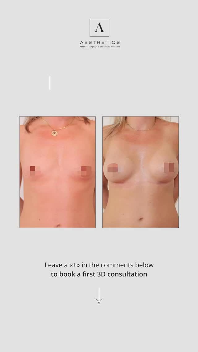 Sometimes, just one step is enough to feel more confident, fall in love with your reflection, and embrace your femininity.
We know that for every woman, beauty is not just about appearance — it’s about a sense of inner strength and comfort in her own body.
Minimally invasive breast augmentation is a gentle path to your ideal result:

- Minimal incision and quick recovery period
- A naturally beautiful look in harmony with your figure
- Individually selected implant shape and volume
- Correction of asymmetry and enhanced fullness in the upper pole of the breast
We will listen to your wishes, consider every detail, and create a result that looks as though it has always been a part of you.
📅 Book your free consultation — and let’s discuss how we can highlight your natural beauty.

You can sign up for a free consultation by calling these numbers ⤵️

📞 Geneva: +41 22 732 22 23 | WhatsApp: +41 79 931 20 66
📞 Montreux: +41 79 908 98 98
📞 Gstaad: +41 79 196 98 69
