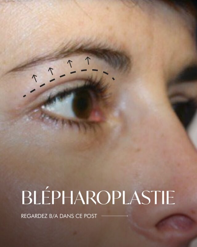 Un regard fatigué ou tombant n’est pas toujours lié à votre humeur, mais souvent à un excès de peau sur les paupières ou à des « poches » sous les yeux. Même si vous êtes pleine d’énergie, vos yeux peuvent trahir la fatigue.
✨ La blépharoplastie est une correction chirurgicale peu invasive des paupières qui permet de :
retirer l’excès de peau et les hernies graisseuses,
lisser les petites rides,
ouvrir le regard et redonner de la fraîcheur au visage.
⚕️ Selon votre cas, l’intervention peut être réalisée sous anesthésie locale ou générale. Le chirurgien choisira l’option la plus confortable et la plus sûre pour vous.
⏳ La récupération est relativement rapide et les résultats se maintiennent pendant de nombreuses années.
📸 Sur la photo, vous voyez le résultat de notre patiente — avant et après l’intervention.
❓Voulez-vous savoir si cette procédure est adaptée pour vous ?

📍Genève: Call +41 22 732 22 23 or WhatsApp us at
+41 79 931 20 66
📍Montreux: Cal +4179 908 98 98
📍Gstaad: Call +41 79 196 98 69

#blepharoplastiegeneva#drTenorio#blepharoplastygeneva#arstheticMedecine#plasticsurgery
