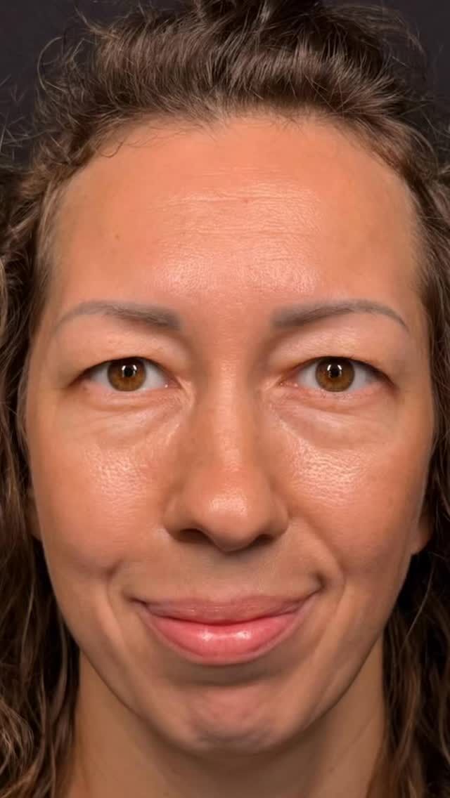 Sometimes the eye area can appear tired:
bags, puffiness, shadows, folds of skin.
Even when you feel full of energy, your eyes may tell a different story.
Blepharoplasty offers a refined solution — smoothing the skin, reducing heaviness, and opening up the gaze.
The result is not about changing who you are, but about restoring lightness, clarity and confidence to your expression. ✨

📩 Book your consultation and discover a subtle approach to eye rejuvenation tailored just for you.

📍Geneva: +41 22 732 22 23
WhatsApp: +41 79 931 20 66
📍Gstaad: +41 79 196 98 69
📍Montreux: +41 79 908 98 98

#médecinesthétiquegenève#blepharoplastygeneva#drtenorio#blepharoplasty