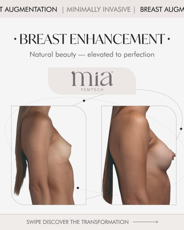 ✨ Dreaming of natural, harmonious breasts without long recovery?
Now it’s possible with the innovative MIA® FEMTECH method.
💎 Minimal intervention
💎 No scars on the breast — incision hidden in the armpit
💎 Just 24 hours for recovery
💎 No anesthesia, no hospitalization
📸 Swipe through the carousel and discover the transformation:
from subtle enhancement to a beautifully balanced shape.
🌸 One day to transform yourself.
A lifetime to enjoy the result.

Geneva: +41 22 732 22 23
WhatsApp: +41 79 931 20 66
Gstaad: +41 79 196 98 69
Montreux: +41 79 908 98 98

#miafemtech#breastaugmentation#minimallyinvasivebreastenhancement#drTenorio#aestheticsclinic#