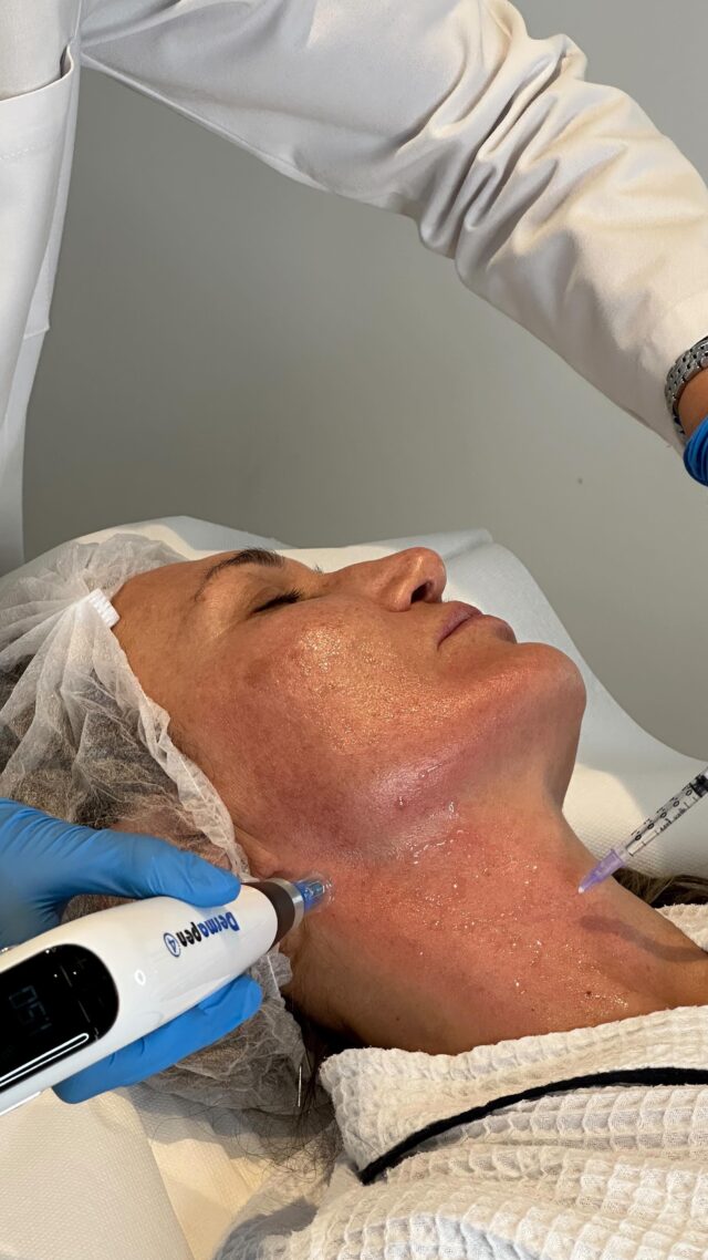 ✨ Why Intensity of Device Is the Key to Skin Rejuvenation?

When it comes to microneedling, lasers, or peels, intensity is what separates a quick glow from real, lasting rejuvenation.

1. Depth = Collagen Activation

- Light, surface-level treatments give a temporary glow.
- Medical-grade intensity penetrates deeper skin layers, stimulating collagen and elastin — the real drivers of firmness and smoothness.

2. Controlled Micro-Injuries = Regeneration

- Stronger settings create precise micro-injuries that trigger your skin’s natural healing response.
- This process rebuilds the skin structure — reducing wrinkles, scars, and uneven texture.

3. Legal Safety Standards

- At-home rollers or cosmetic devices are legally limited to very shallow needle depths — usually no more than 0.3 mm.
- In a medical clinic, licensed professionals can lawfully use deeper microneedling (up to 2.5 mm), which is essential for collagen remodeling and true rejuvenation.

Go to our “Lasers” highlights to benefit from our seasonal offer 💫

#médecinesthétiquegenève#drtenorio#dermapen#antipigmentation#Genesis#prpgeneva#CO2lasergeneva