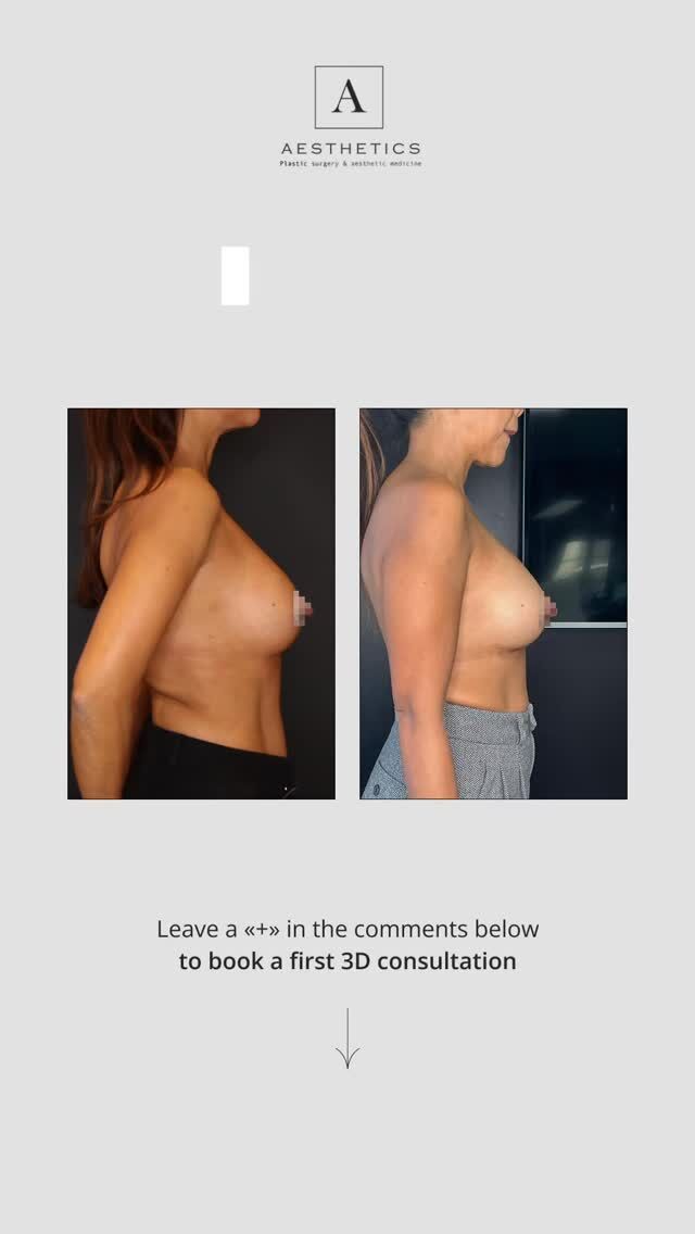 ✨ IMPLANTS CHANGE — same size, new harmony
Our patient came to us with breast asymmetry, implant descent, and contour irregularities.
Her previous implants had a ribbed, wavy surface, which caused uneven contours and a less natural look in movement and lighting.
There was also loss of upper pole firmness and discomfort in clothing and daily activities.
During surgery, Dr. Xavier Tenorio performed an IMPLANTS CHANGE — replacing the anatomical 330cc implants while preserving the same volume but completely transforming the shape, position, and symmetry.
The implant pockets were refined, tissue balance restored, and natural projection regained.
The result — soft, symmetrical, and harmonious breasts, with a smooth contour and natural movement.
No size increase — just precision, aesthetics, and attention to every detail.
💫 Considering your own IMPLANTS CHANGE?
Book your consultation with Dr. Tenorio and discover what’s possible for you.

#implantschange#aestheticsclinic#drtenorio#breastaugmentation#augmentationmammaire