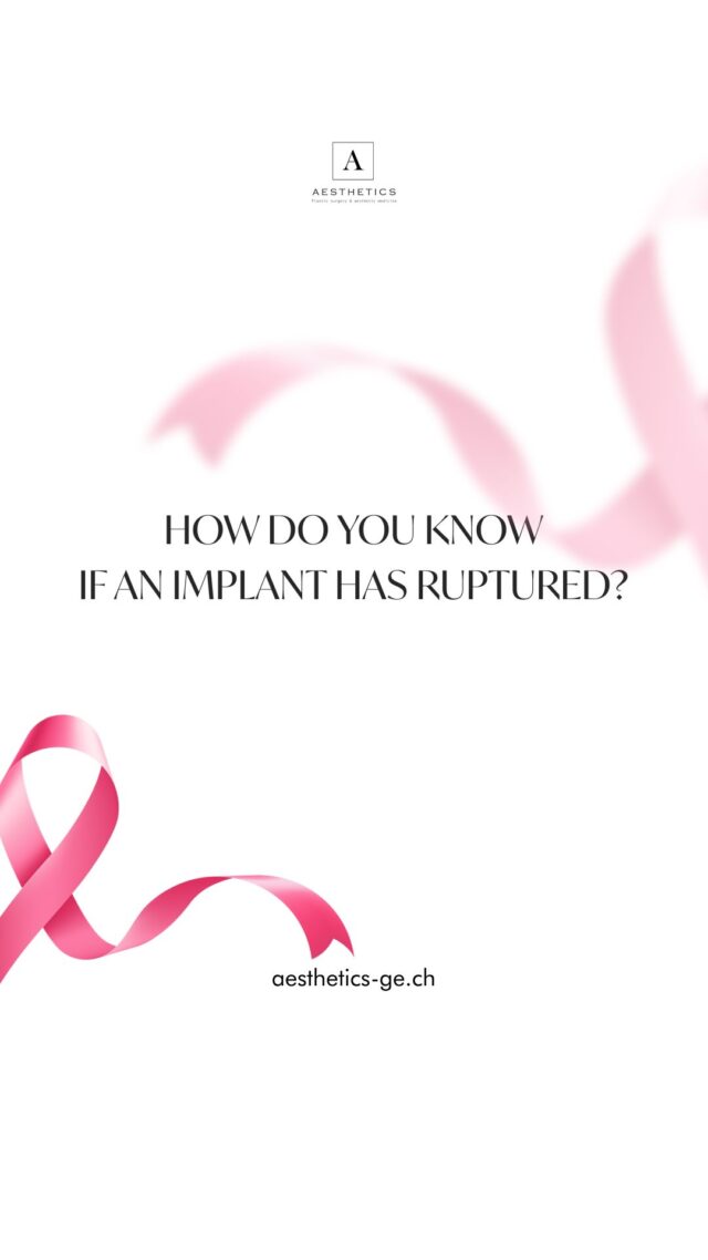 Silicone implants today are extremely safe and stable, but even if a small rupture happens, the breast can look completely normal. No pain, no change, no clue.
That’s why a yearly control is essential — a quick ultrasound or MRI gives you full confidence that everything is perfect.
💖 Regular checks mean:
— peace of mind,
— long-term safety,
— and the freedom to act early if needed.
And the best part?
In Switzerland, insurance often covers this annual implant check-up.
📅 Take care of yourself — book your control today and keep your confidence shining from the inside out.

📍Geneva: +41 22 732 22 23 WhatsApp: +41 79 931 20 66
📍Gstaad: +41 79 196 98 69
📍Montreux: +41 79 908 98 98

#breastcancer#imlantscheck#octoberrose#drTenorio#aestheticsclinic#octoberrosé#implantschange