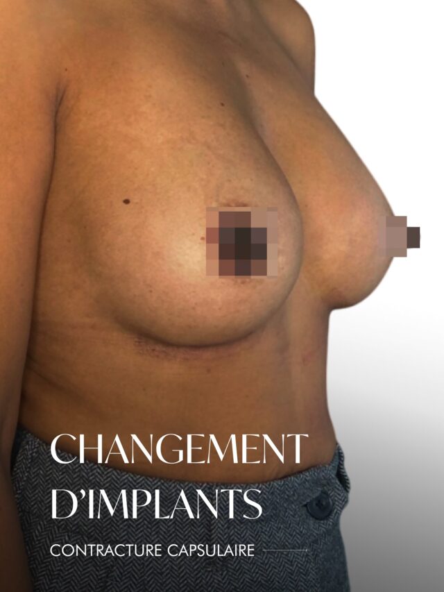💎 Restauration de la forme de la poitrine en cas de contracture capsulaire

Avec le temps, il peut se former autour d’un implant une capsule fibreuse qui, dans certains cas, devient trop rigide. Cette contracture capsulaire peut modifier la forme du sein, le rendre plus ferme, asymétrique ou provoquer une sensation d’inconfort.

La chirurgie de remplacement permet aujourd’hui de corriger cette situation avec précision et douceur.
L’intervention consiste à retirer la capsule formée et à remplacer l’implant, afin de redonner à la poitrine sa forme naturelle, sa souplesse et son équilibre.

✨ Après cette restauration, les patientes retrouvent une sensation de légèreté, d’harmonie et de confiance en leur féminité.

📩 Prenez rendez-vous pour une consultation personnalisée — nous évaluerons ensemble la situation et vous proposerons la solution la plus adaptée pour retrouver une poitrine naturellement belle et confortable.

Contactez-nous :
📍Genève: Appelez le +41 22 732 22 23 ou
WhatsApp au +41 79 931 20 66
📍Montreux: Appelez le +41 79 908 98 98
📍Gstaad : Appelez le +41 79 196

#implantschange#breastaugmentation#drTenorio#augmentstionmammairegeneva#implantsmammaires#aestheticsclinic