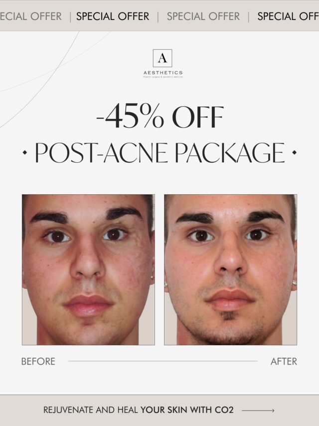 ✨ Reclaim your confidence — reveal smooth, flawless skin.
Our exclusive Post-Acne Package is designed to fade scars, even out skin tone, and restore your natural glow.
💉 PRP + Dermapen – stimulate collagen and accelerate skin healing.
💨 CO₂ Laser – refine texture, tighten pores, and smooth post-acne marks.
✨ The results:
– Visible scar reduction
– Less redness and pigmentation
– Softer, clearer, radiant skin
💎 Don’t miss the chance to get your Post-Acne Package at a special -45% rate!
✨ Purchase your voucher in our “Laser” Highlights on Instagram.
📅 Offer valid until November 5, 2025.
#postacnescars#laserCo2#aestheticsclinic#Dermapenantipigmentations#