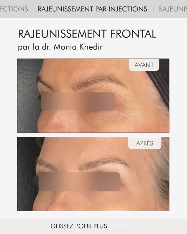 ✨ Rajeunissement complet de la partie supérieure du visage — sans chirurgie.
Les rides du front, la ride du lion, les cernes sous les yeux… tout cela peut alourdir le regard.

💉 Le rajeunissement par injections, réalisé par la Dr. Monia Khedir, agit de façon globale :
il détend les muscles, lisse la peau et restaure les volumes naturels tout en préservant vos expressions.

▫️Grâce à la combinaison de plusieurs techniques précises, la Dr. Khedir obtient non seulement une correction des rides,
mais un rajeunissement harmonieux — pour un regard ouvert, un front lisse et un visage naturellement reposé.

📅 Ne manquez pas le BLACK FRIDAY dans nos Aesthetics clinic— du 24 au 30 novembre.

✔️Profitez de –50% → 345 CHF au lieu de 690 CHF.
Laissez un « + » en commentaire pour recevoir votre bon personnel.⤵️

#medecinesthetiquegeneve#rajeunissementparinjections#fillersgeneva#softlift#liftingduvisage