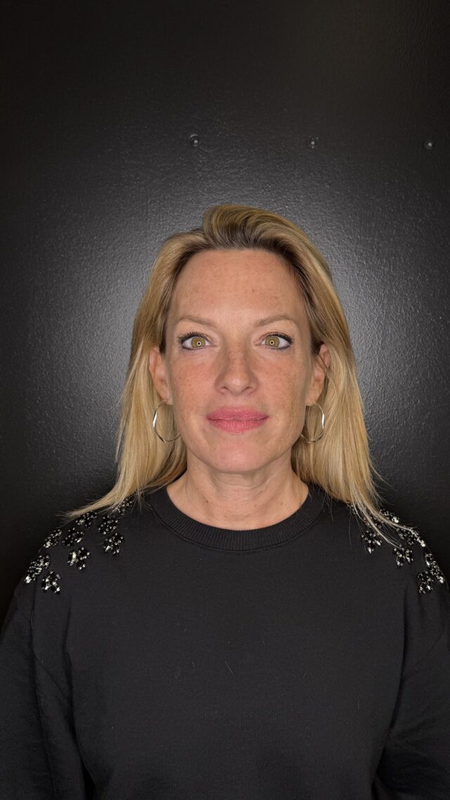 ✨ Régénération cutanée avec la Dr. Monia Khedir ✨

La docteure Monia Khedir a réalisé une analyse approfondie de la peau de notre magnifique patiente Maëlle.
Elle a observé un léger relâchement cutané, une sécheresse de la peau, l’apparition de fines ridules ainsi que de petites zones de pigmentation — des signes naturels du temps qui nécessitent une approche experte et tout en douceur.

💎 Grâce à son expérience et à son sens esthétique raffiné, la docteure Monia Khedir a mis en place un protocole personnalisé visant à améliorer la qualité de la peau, renforcer sa tonicité et sa densité, et raviver son éclat naturel.

L’objectif : un lifting subtil et harmonieux, une peau fraîche, lumineuse et pleine de vitalité, sans altérer l’expression ni la beauté naturelle du visage.
L’approche de la docteure Monia Khedir allie science, précision et élégance, pour des résultats à la fois visibles et naturels.

✨ Envie de découvrir le résultat de Maëlle ? Restez connectés pour la suite !

#aestheticsclinic#beautéNaturelle #antiage #soindelapeau #médecineesthétique #liftingnaturel #éclatnaturel#vhaker#injections#liftingduvisage