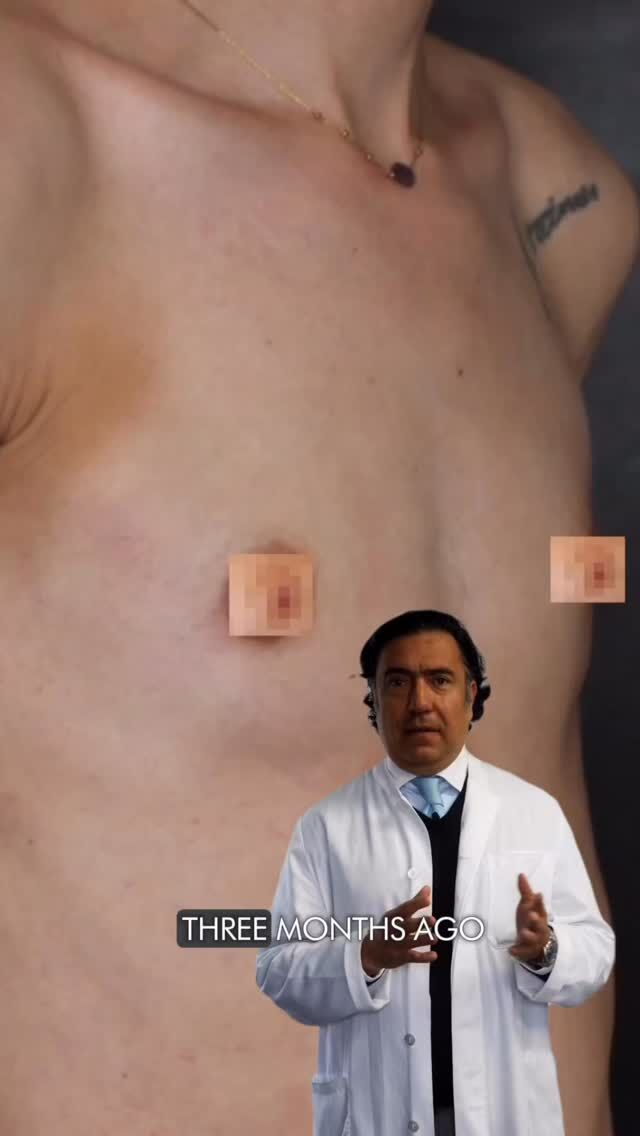 🎥 Breast augmentation result — 3 months post-op
The shape has fully settled: the breasts are soft, mobile, and naturally contoured.
The patient has a distinctly athletic body type — defined musculature, minimal soft tissue, and almost no breast gland.
With this physique, it’s not just about adding volume, but creating a balanced, anatomically precise shape that complements the muscle structure and overall silhouette.
👨‍⚕️ Dr. Tenorio performed submuscular placement of medium-projection anatomical implants, carefully defining the inframammary fold and a smooth transition to the upper pole.
The result — natural, proportional breasts with no “implant look” and full preservation of the athletic aesthetic.
✨ Want a refined, harmonious shape?
Book a consultation and discover what result would suit you best.

📞 CONTACTS:
📍 Geneva: +41 22 732 22 23
📲 WhatsApp: +41 79 931 20 66
📍 Gstaad: +41 79 196 98 69
📍 Montreux: +41 79 908 98 98