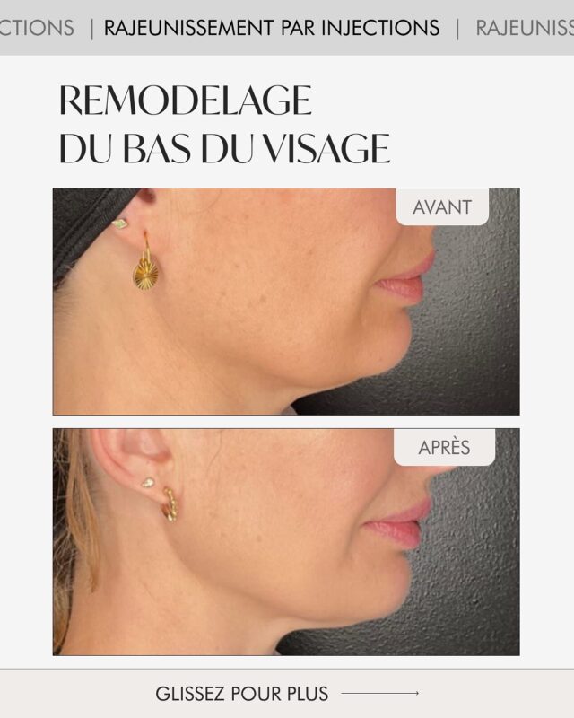 ✨ Rajeunissement par injections — des contours naturels, un regard frais, un visage rajeuni
Avec le temps, les contours se floutent, la peau perd de sa fermeté et les traits paraissent plus fatigués.

La procédure de rajeunissement par injections permet de :
💉 restaurer les volumes et l’harmonie du visage
💎 redéfinir les lignes naturelles
💫 redonner à la peau densité et éclat — en une seule séance
Notre experte, DRe Monia Khedir , combine plusieurs techniques modernes pour obtenir un résultat naturel, équilibré et sans effet de surcharge.

📸 Regardez le résultat avant/après : les bajoues et le double menton ont disparu, les contours du visage sont plus nets et l’expression plus jeune et lumineuse.
🖤 Ne manquez pas notre offre spéciale BLACK FRIDAY du 24 au 30 novembre !
Profitez de –50% sur la procédure de rajeunissement par injections
💶 345 CHF au lieu de 690 CHF

▫️Laissez un “+” en commentaire pour recevoir votre bon dès le 24 novembre.

#rajeunissementparinjections#softliftgeneva#fillersgeneva#skinboostergeneva#aestheticsclinic#injectionsvisagegeneve#liftingnaturel