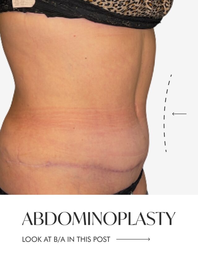 The abdomen is one of the areas that changes the most throughout life: pregnancy, weight fluctuations, reduced muscle tone, stretched skin…
And sometimes, even with regular exercise and a healthy lifestyle, it becomes impossible to restore the previous contour.

▫️Abdominoplasty offers a comprehensive solution:
it allows you to remove excess skin, tighten and reinforce the abdominal wall (when needed), and restore a smoother, firmer, and more harmonious appearance.

For many women, this procedure brings not only an aesthetic improvement but also a renewed sense of comfort and confidence.

✨ What abdominoplasty can offer:
• a flatter and more refined abdomen
• restoration of the natural waistline
• improved posture thanks to muscle repair
• elimination of skin folds and discomfort
• more freedom of movement and comfort in clothing
Every case is unique, and the result is always tailored to the patient’s anatomy, lifestyle, and expectations.

▫️The photos in the carousel show how the body contour can change: smoother skin, clearer lines, and a more balanced silhouette.
Would you like to know if this procedure is right for you?

Book a free consultation — our experts will answer all your questions, assess your needs, and recommend the most suitable treatment plan.

 CONTACTS:
📍 Geneva: +41 22 732 22 23 📲 WhatsApp: +41 79 931 20 66
📍 Gstaad: +41 79 196 98 69
📍 Montreux: +41 79 908 98 98

#abdominoplastygeneva#DrTenorio#aestheticsclinic#abdominoplastía#breastaugmentationgeneva#rhinoplasty#abdominoplastysurgery