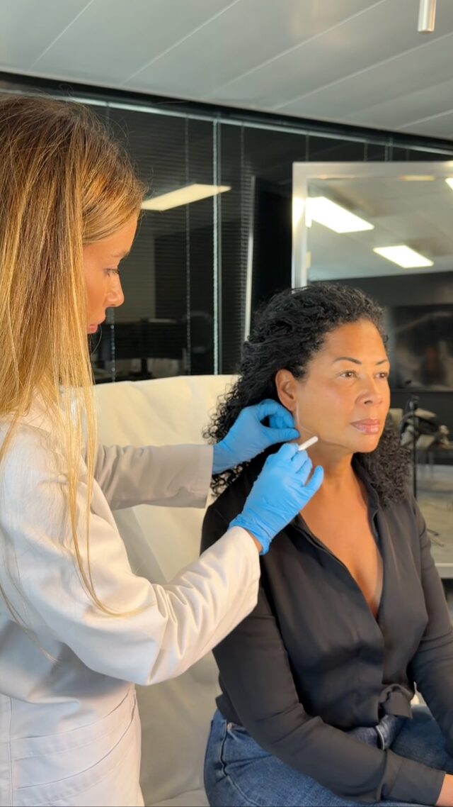 Today we move forward with Tonia’s story and take a closer look at what happened during her second Soft Lift session.
In the first treatment, the focus was on restoring midface support — adding volume to the cheekbones and rebuilding structural balance.
Now it was time to address the area that mattered most to her: the chin line.
Tonia’s main concern was the uneven, “wavy” contour of the chin that disrupted the clarity of her lower face.
During this session, Dr. Yulia worked on correcting that foundation — establishing support points, adjusting vector directions, and reinforcing areas where the tissue lacked stability.
This stage helps smooth irregularities, refine the chin profile, and bring a cleaner, more harmonious shape to the lower third of the face.
It creates the structural base needed for the next phase, where fine adjustments will complete the transformation.
The second session is now behind us, and the change in facial geometry is already becoming noticeable.
In our next update, you’ll see how Tonia’s features begin to come together with beautiful precision.
Stay with us — her journey is unfolding step by step.