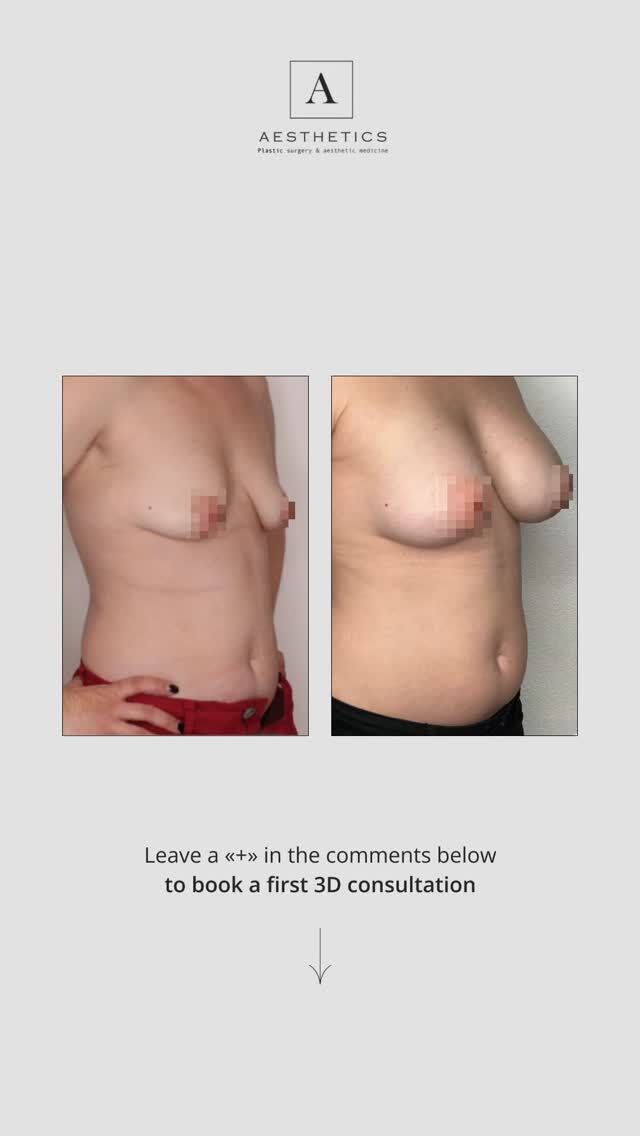 Tuberous breast cases require more than standard augmentation.
It’s not just about adding volume — it’s about reshaping structure, releasing constricted tissue, and restoring natural proportions.

In this case, the focus was on creating a natural lower pole, correcting asymmetry, and bringing harmony to the overall silhouette. Every step is carefully tailored to the patient’s anatomy to achieve a refined and balanced result.

This is where Dr. Tenorio’s surgical precision makes the difference — subtle adjustments with a truly transformative impact.

Considering breast correction or augmentation?
Book your complimentary consultation to discuss the best approach for you.