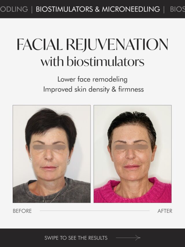 BIOSTIMULATORS: NATURAL SKIN REGENERATION

This treatment is not about adding volume —
it’s about restoring your skin from within.

Biostimulators activate fibroblasts and stimulate new collagen production, improving skin structure over time.

In this case, we focused on:

• improving skin density
• redefining the jawline
• restoring firmness
• achieving a natural lifting effect

✨ The result is progressive rejuvenation — natural, balanced and long-lasting.

Unlike fillers, biostimulators work gradually, helping your skin rebuild its own structure.

SPRING SKIN REPAIR –40%

You can purchase your collagen regeneration program
online in our Highlights (SKIN REPAIR).