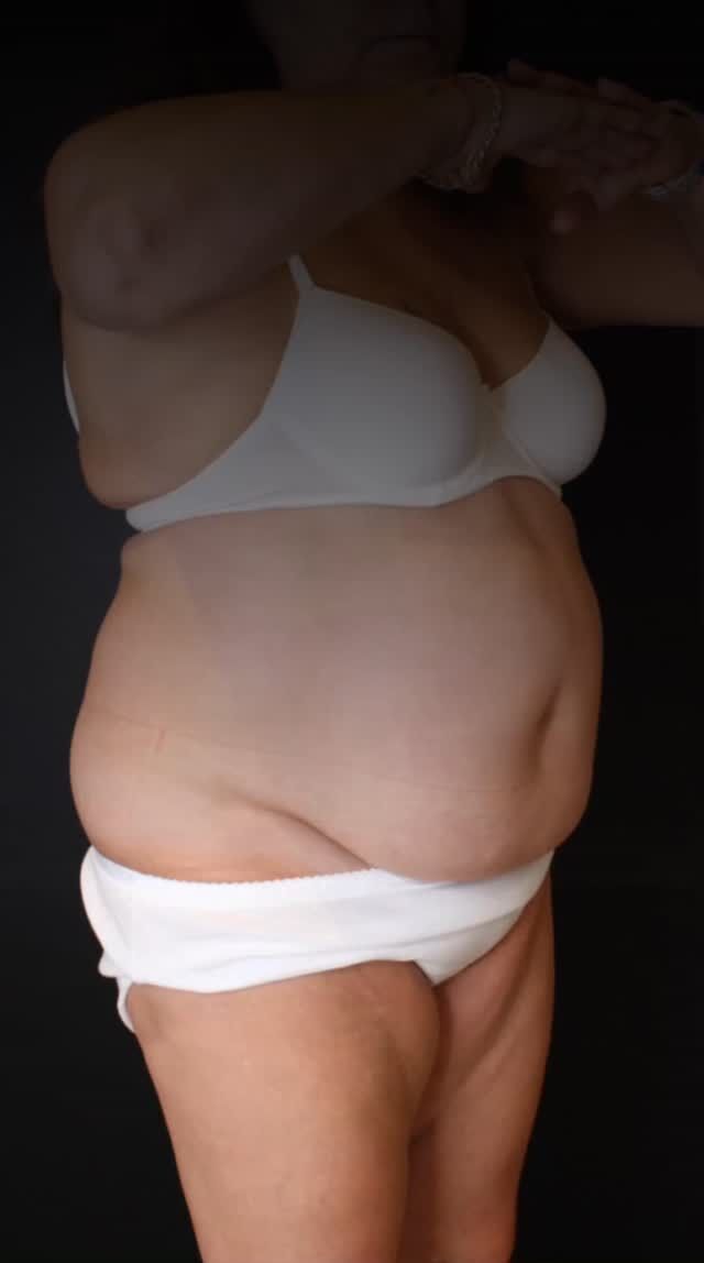 This result was achieved
through a combined approach ◻️

◾️ Circular liposuction helped remove
localized fat deposits,
◾️ GLP-1 therapy (Ozempic)
supported overall weight loss
and reduction of intra-abdominal fat.

It’s important to understand
that subcutaneous fat
and visceral fat
are two different types of fat tissue.

◽️Liposuction works
on subcutaneous fat
to improve body contours.

◽️GLP-1 therapy, on the other hand,
affects appetite,
metabolism,
and the overall weight loss process —
including reduction of visceral fat,
which cannot be removed with liposuction.

That is why,
in some cases,
combining these approaches
can create a more balanced
and harmonious result 

Book your free consultation
to understand
which approach
may be right for you 

📍Geneva: Call +41 22 732 22 23 or WhatsApp +41 79 931 20 66
📍Montreux: Call +41 79 908 98 98
📍Gstaad: Call +41 79 196 98 69 

#Liposuction#BodyContouring #GLP1 #Ozempic#WeightLossJourney#AestheticClinic#SelfConfidence