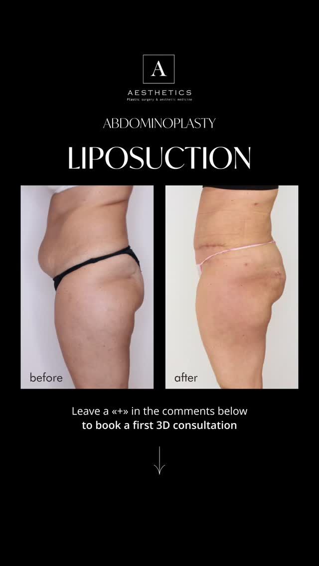 **Patient case: 360° liposuction + abdominoplasty**

In this case, the patient came to us with the wish to improve the contour of the abdomen, waist and overall body silhouette.

After an in-person consultation and a careful assessment of her anatomy, the decision was made to perform a combined procedure: **360° liposuction** and **abdominoplasty**.

This approach allows the surgeon to address not only localized fat deposits, but also excess skin in the abdominal area, which cannot be corrected with exercise or non-surgical treatments alone.

**What was performed:**

• 360° liposuction to refine the contour of the waist, abdomen, flanks and back
• Abdominoplasty to remove excess skin and restore a smoother abdominal line
• A balanced reshaping of the silhouette, adapted to the patient’s individual anatomy

It is important to understand that these procedures are not a method of weight loss. They are surgical body-contouring procedures designed for patients with specific indications and realistic expectations.

The final result always depends on the initial anatomy, skin quality, tissue volume, healing process and adherence to post-operative recommendations.

During the consultation, the surgeon evaluates not only the aesthetic concern, but also the patient’s overall health, possible contraindications, the extent of the procedure and the most appropriate surgical plan.

If you are considering a correction of the abdomen, waist or body contours, we invite you to book a consultation with **Dr Tenorio**.

Dr Tenorio will assess your case in detail, explain the available options and help you understand which approach may be the most suitable for you.

Book your consultation with Dr Tenorio 

Connect with us:
📞 Geneva: +41 22 732 22 23 | WhatsApp: +41 79 931 20 66
📞 Montreux: +41 79 908 98 98
📞 Gstaad: +41 79 196 98 69 

#Liposuction
#Abdominoplasty
#BodyContouring
#PlasticSurgeryGeneva
#AestheticsClinicGeneva