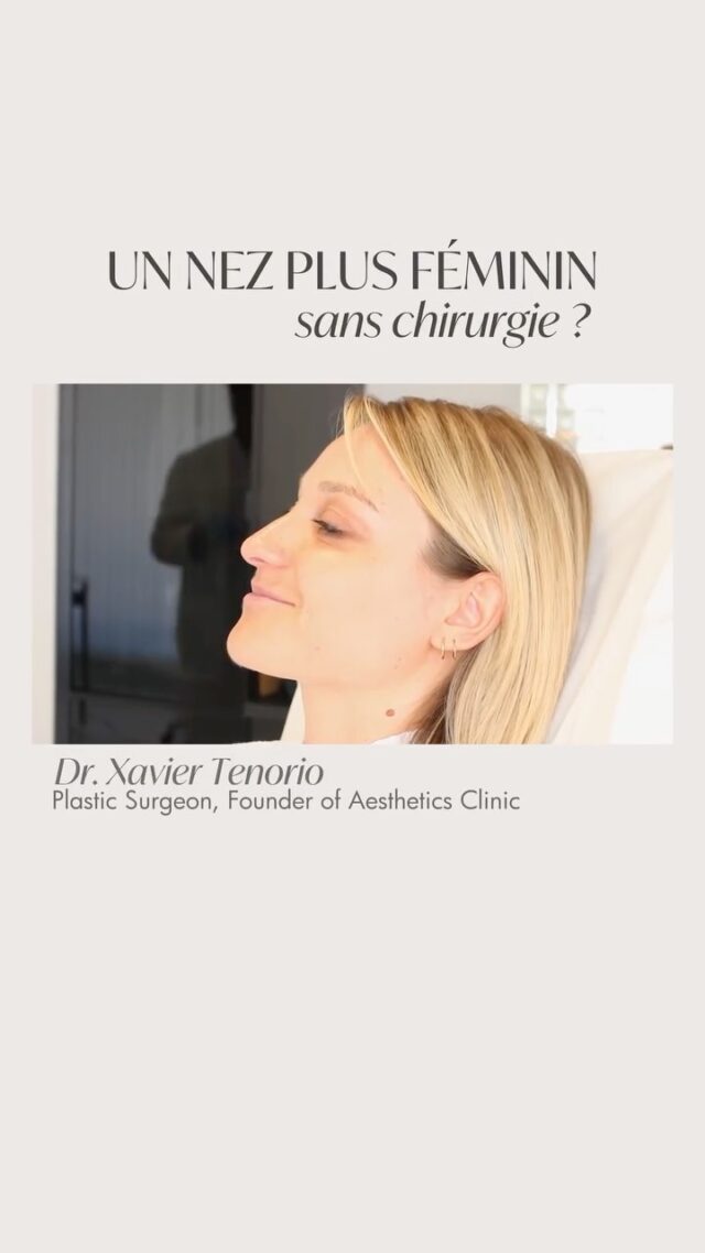 Tous les patients qui souhaitent modifier la forme de leur nez n’ont pas nécessairement besoin d’une intervention chirurgicale❕ 

◽ Dans certains cas, quelques injections réalisées avec précision suffisent à adoucir le profil et à lui donner une apparence plus féminine.

Une connaissance approfondie de l’anatomie, le sens des proportions et la compréhension de l’équilibre global du visage sont essentiels pour obtenir un résultat naturel.

Lors de la consultation, le Dr Tenorio évalue le nez, mais aussi son équilibre avec le menton, les lèvres et les autres traits du visage.

◾ Cette analyse permet de déterminer si une correction par injections peut répondre à vos attentes ou si une rhinoplastie chirurgicale serait plus adaptée.

Prenez rendez-vous pour une consultation via le lien dans notre bio afin de découvrir la méthode de correction qui vous convient le mieux. ↗