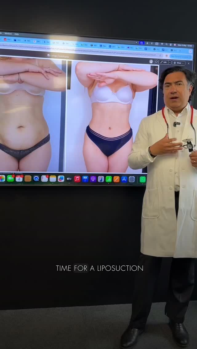 Localized fat deposits can remain even with a balanced diet and regular exercise.
The abdomen, flanks, thighs, or under-chin area — sometimes it’s not about weight, but about how fat is distributed in the body.
Liposuction helps correct these areas and create more defined, harmonious body contours. 
The goal of the procedure is not simply to remove fat, but to preserve natural proportions and achieve a result that suits your body.
Depending on the treatment area and technique, liposuction may be performed under local anesthesia, while the return to your normal routine happens gradually as the body recovers. 
At Aesthetics Clinic, Dr. Tenorio creates an individual correction plan based on your anatomy, body proportions, desired result, and the most suitable technique.

Thinking about liposuction?
Book a consultation through the link in our bio and discover which correction option may be right for you. 

#liposuctiongeneva #aestheticsclinic #drTenorio #médecinesthétiquegenève #liposucciongenève